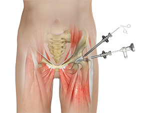 Hip Arthroscopy