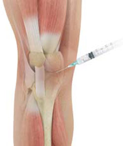 Cortisone Injection