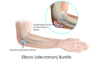 Elbow Bursitis