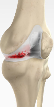 Knee Arthritis Management