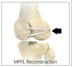 Medial Patellofemoral Ligament Reconstructionmpfl