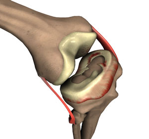 Meniscus Tear Surgery