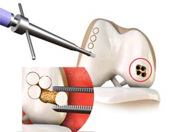 Oats Procedure