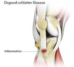 Osgood Schlatter Disease