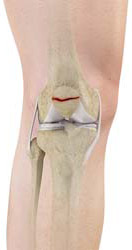 Patella Fracture