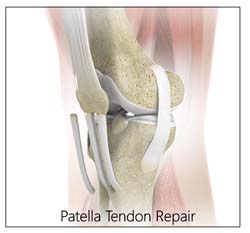 Patella Tendon Repair