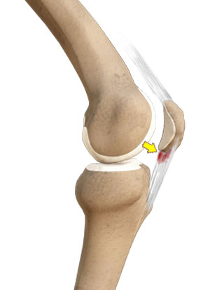 Patellar Tendinitis