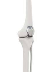 Patellofemoral Replacement