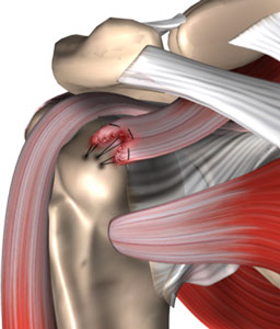 Arthroscopic Rotator Cuff Repair